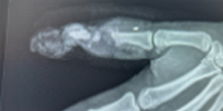 X-ray showing thumb injury